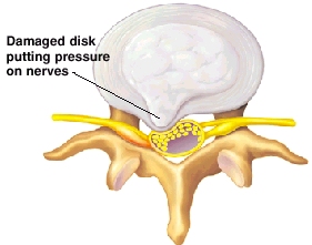 Image of a damaged disk.