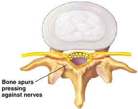 Image of bone spurs.