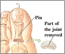 Image of the big toe joint  showing the part of the joint removed and a pin connecting the bones