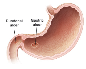 Cross section of stomach showing gastric and duodenal ulcers.