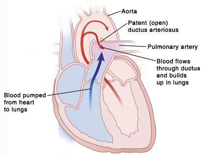 Cross section of heart showing patent ductus arteriosus.