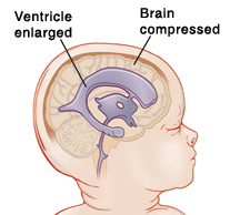 image of enlarged ventricle inside of compressed brain.