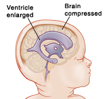 image of enlarged ventricle inside of compressed brain.