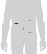 Image of incision sites