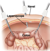 Image of laparoscope inserted into colon