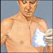 Image of removing dressing