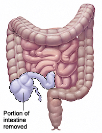 Image of the intestines with the portion of intestine to be removed highlighted.