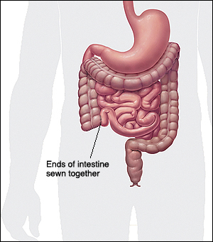 Image of the intestinges showing the ends of intestine sewn together