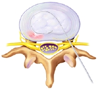 Image showing the catheter being threaded through a needle into the disk.