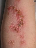 Impetigo of Elbow