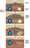 invasion and metastasis