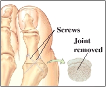 Image of big toe joint showing joint removed and screws fusing the bones together