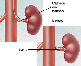 Kidney with balloon inserted into renal artery. Kidney with stent placed in renal artery.