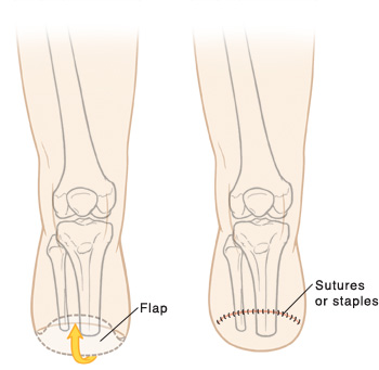 Leg showing amputation below knee. Flap of skin from back of leg covers end of leg. Leg showing amputation below knee. Sutures or staples hold flap of skin in place.