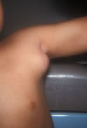Lymph Node Swelling - Axillary