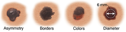 Four skin cancers showing asymmetry, borders, colors, and diameter.