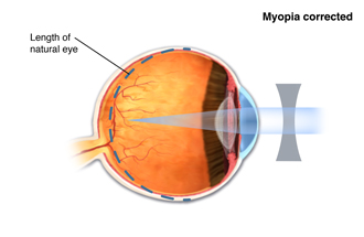 Myopia corrected