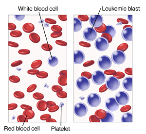 Microscopic view of blood cells comparing normal blood and leukemia.