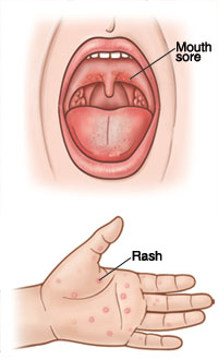 HFMD can cause mouth sores and a rash on areas such as the hands, feet, or buttocks. Open mouth showing sore on back of roof of mouth. Closeup of palm of hand showing red rash.