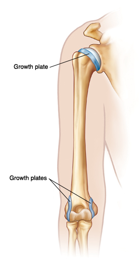 Outline of arm showing upper arm bone. Growth plates are at top of bone near shoulder, and at both sides of bottom of bone near elbow.