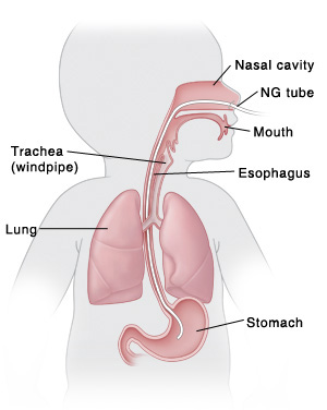 The NG tube is inserted through your child’s nose, down the esophagus, and into the stomach. Outline of baby with head turned to side showing mouth, esophagus, stomach, nasal cavity, trachea (windpipe), and lungs. NG tube is inserted in nose, through esophagus, and into stomach.