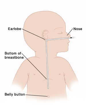 Outline of baby with head turned to side showing NG tube in nose, down back of throat, into esophagus, and ending in stomach. Lungs are shown in chest with airway in front of esophagus. Mark on NG tube is at nose.