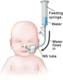 Outline of baby's head and chest showing NG tube in nose connected to feeding port and feeding syringe. Water in feeding syringe flows into baby through NG tube.