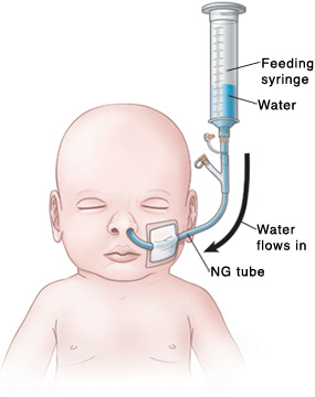 Outline of baby's head and chest showing NG tube in nose connected to feeding port and feeding syringe. Water in feeding syringe flows into baby through NG tube.