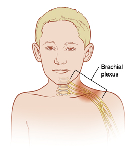 Stingers are caused by injury to the brachial plexus. Outline of boy showing nerves coming from spine in neck and going down arm. Brachial plexus is group of nerves in neck and shoulder.