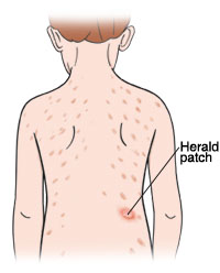 With pityriasis rosea, an itchy rash appears on the back and chest. It often starts with a single large patch called a “herald patch.” Outline of child from back showing rash on back. One large spot of rash is herald patch.