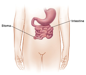 A stoma is an opening in the body made by rerouting the end of the intestine through the abdominal wall to the skin. Outline of child's abdomen showing stomach and intestine. End of intestine goes through abdomen to make stoma.
