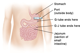 Outline of child's abdomen showing stomach and small intestine. Port is outside body over stomach. Tube is connected to port and goes through skin. G-tube ends in stomach. G-J tube ends in jejunum (section of small intestine).