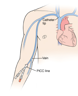 Outline of human figure with catheter inserted into right arm at elbow. Two ports are at end of catheter. Catheter can be seen going up arm vein into heart.