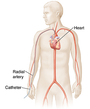 Outline of male figure showing transradial cardiac catheterization.