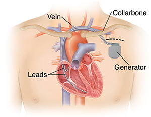 Outline of man's chest showing implantable cardioverter defibrillator in chest with leads going into heart chambers.