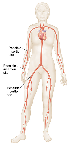Outline of woman showing major arteries and veins, heart, and possible catheter insertion sites.