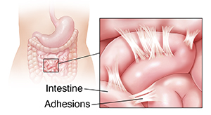 Outline of woman showing stomach and intestines. Inset shows adhesions.