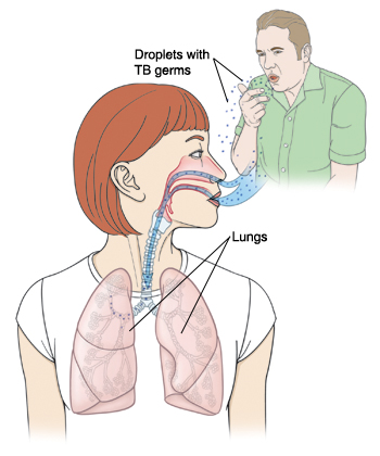 Outline of woman's head and chest with head turned to side. Inside of nose, airway, and lungs are visible. Man in background is coughing out droplets with TB germs. Droplets are being breathed in to woman's nose and lungs.