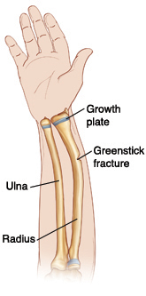 Palm view of hand and forearm showing radius and ulna. Greenstick fracture goes partway through radius. Growth plates are near wrist.