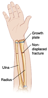 Palm view of hand and forearm showing radius and ulna. Nondisplaced fractures go across radius and ulna. Ends of bones are lined up. Growth plates are near wrist.