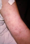 Penicillin Rash on the Arm