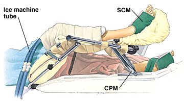 Person lying in hospital bed with one knee supported by continual passive motion machine. Knee is wrapped, and ice machine tubes go under wrapping. Sequential compression cuffs are wrapped around both feet.