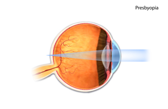 Presbyopia