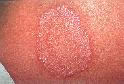 Ringworm Rash on Arm