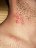 Shingles on Neck