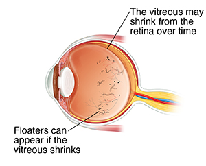 Side view cross section of eye showing vitreous shrinking and floaters.