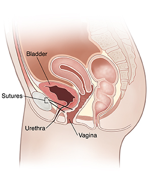 Side view cross section of female pelvis showing retropubic suspension.