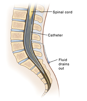 Side view cross section of lower spine showing spinal cord and spinal nerves in spinal canal. Catheter is inserted in skin between two vertebrae and into spinal canal next to nerves. Catheter is draining fluid from space around spinal nerves. 