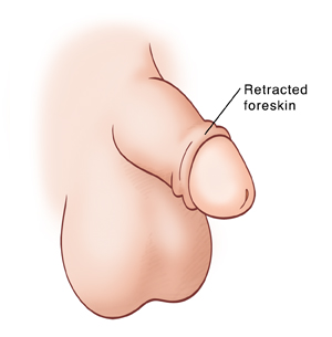 Side view of child's uncircumcised penis with retracted foreskin.