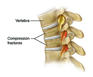 Side view of four vertebrae and disks showing compression fractures.